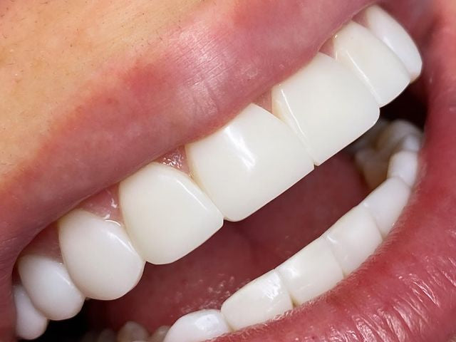 Composite Bonding