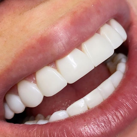 Composite Bonding